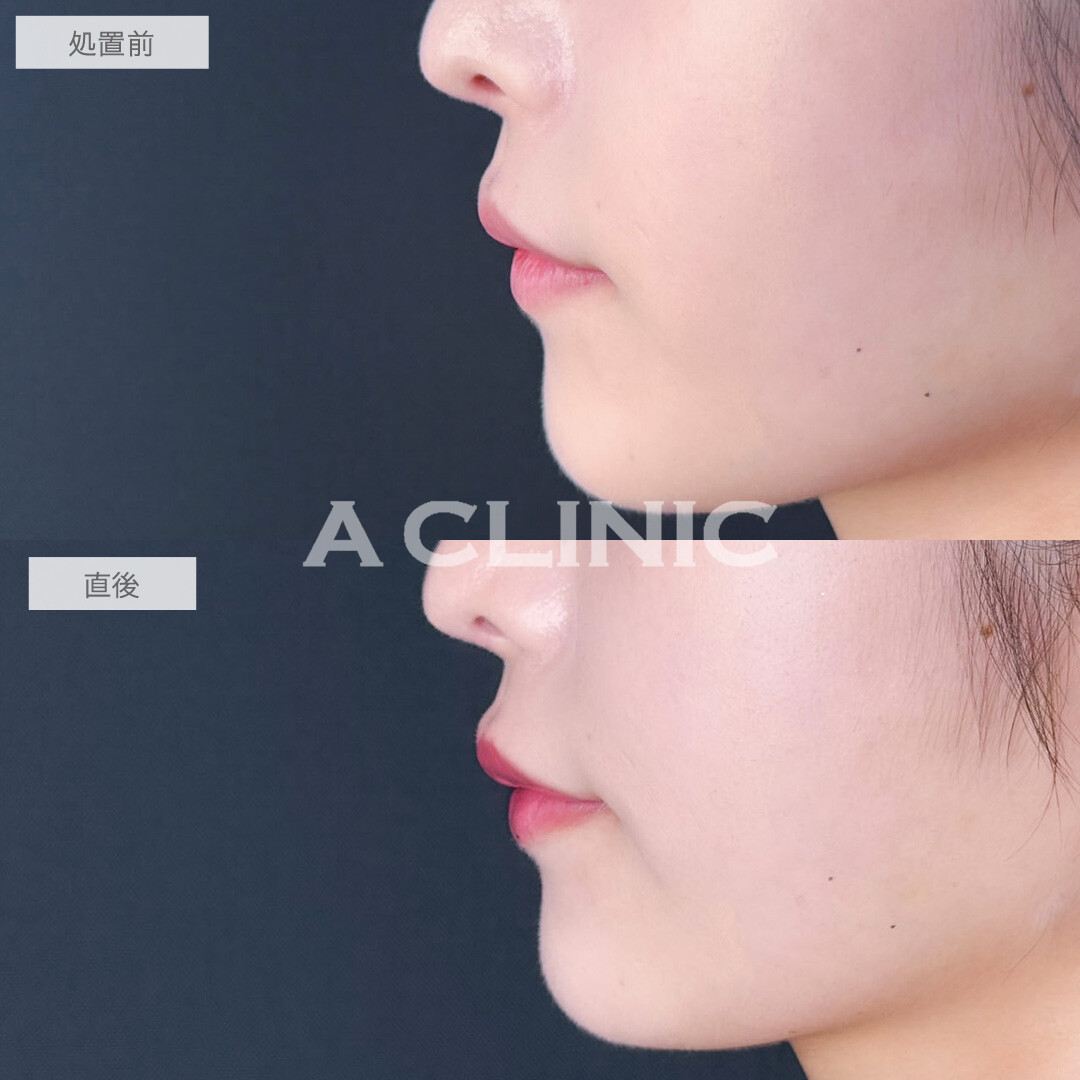 スマイルリップでさりげなく印象チェンジ！こちら処置前と直後の症例です(20代女性)