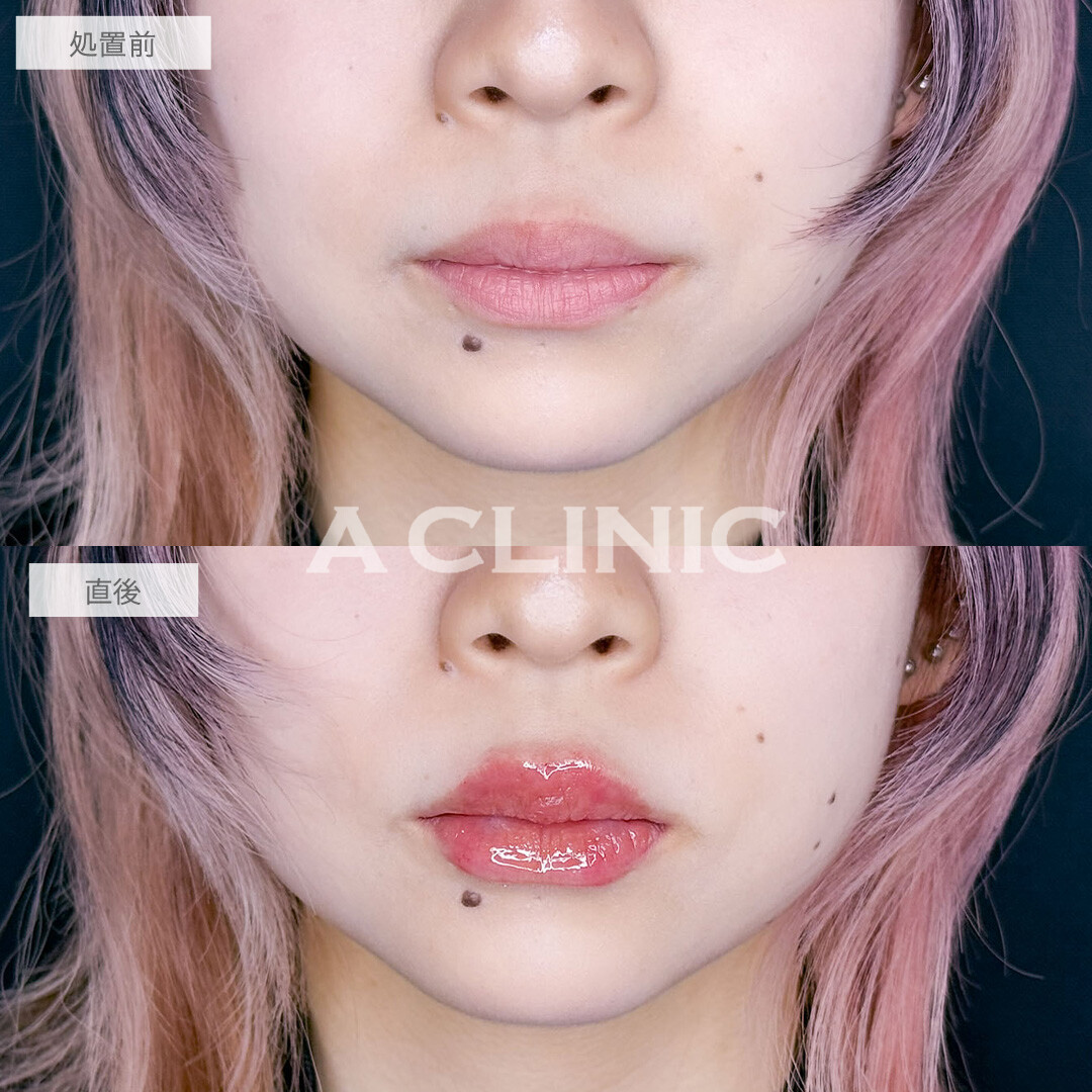 スマイルリップでボリューム感のある魅力的な唇に！こちら処置前と直後の症例です(10代女性)