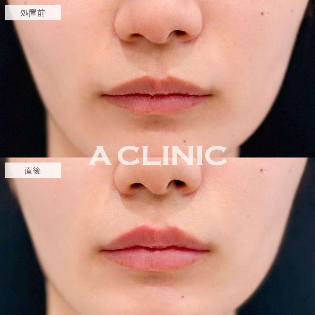 リップヒアルロン酸注入でナチュラルにボリュームアップしM字のぷっくり可愛らしい唇になりました！処置前と直後の症例です(20代女性)