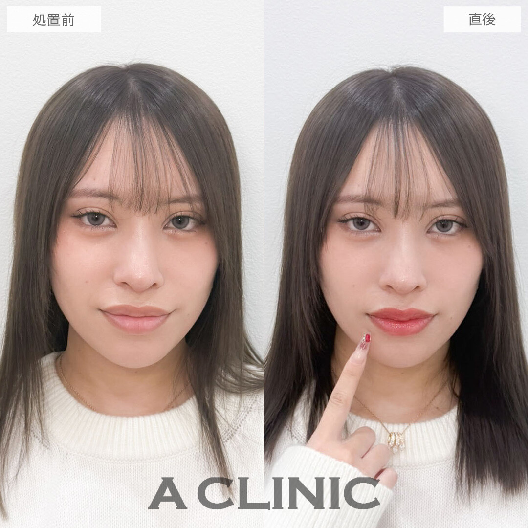 スマイルリップで理想の唇を実現させます！こちら処置前と直後の症例です(20代女性)