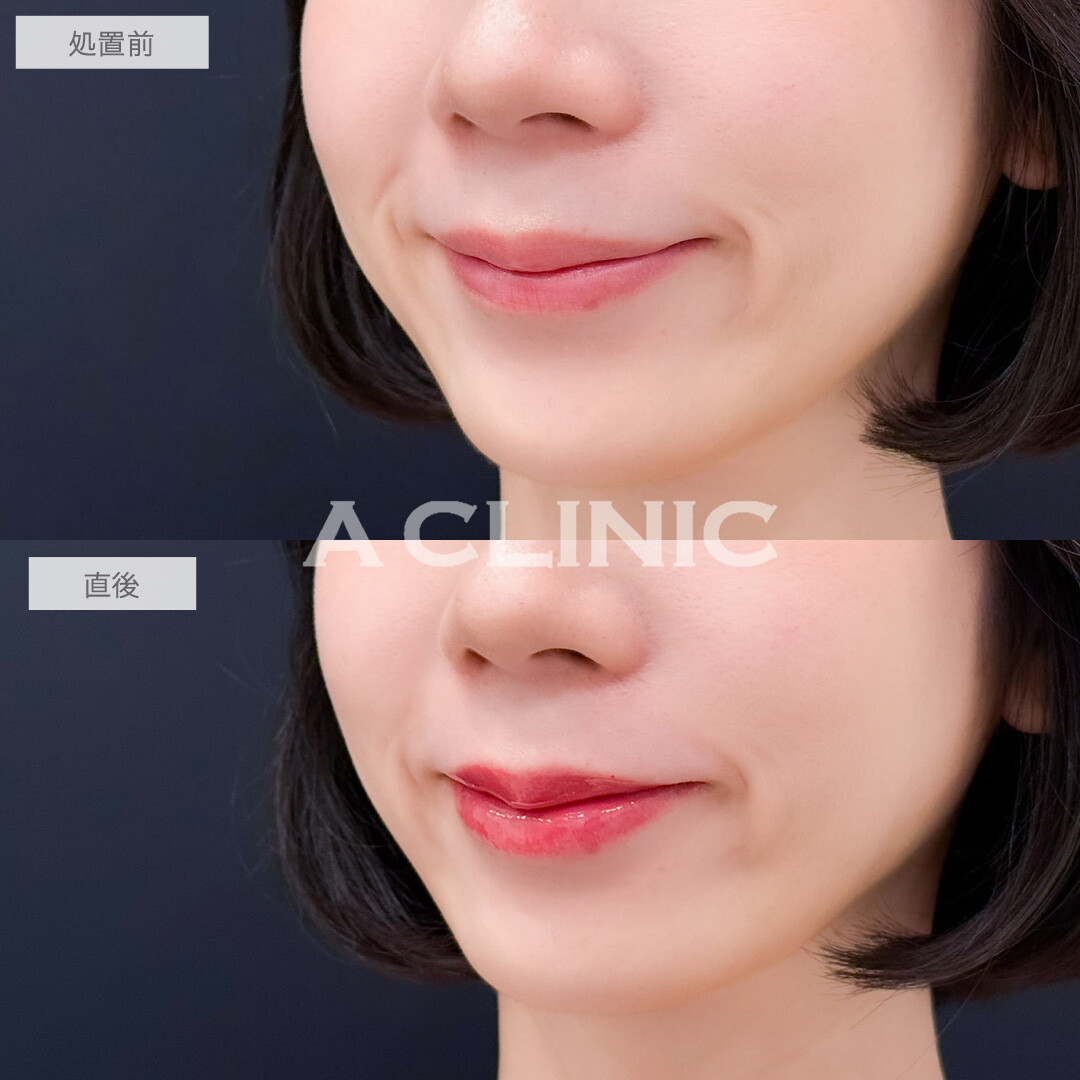 スマイルリップで唇にボリューム感が出てより魅力的な雰囲気に！こちら処置前と直後の症例です(30代女性)