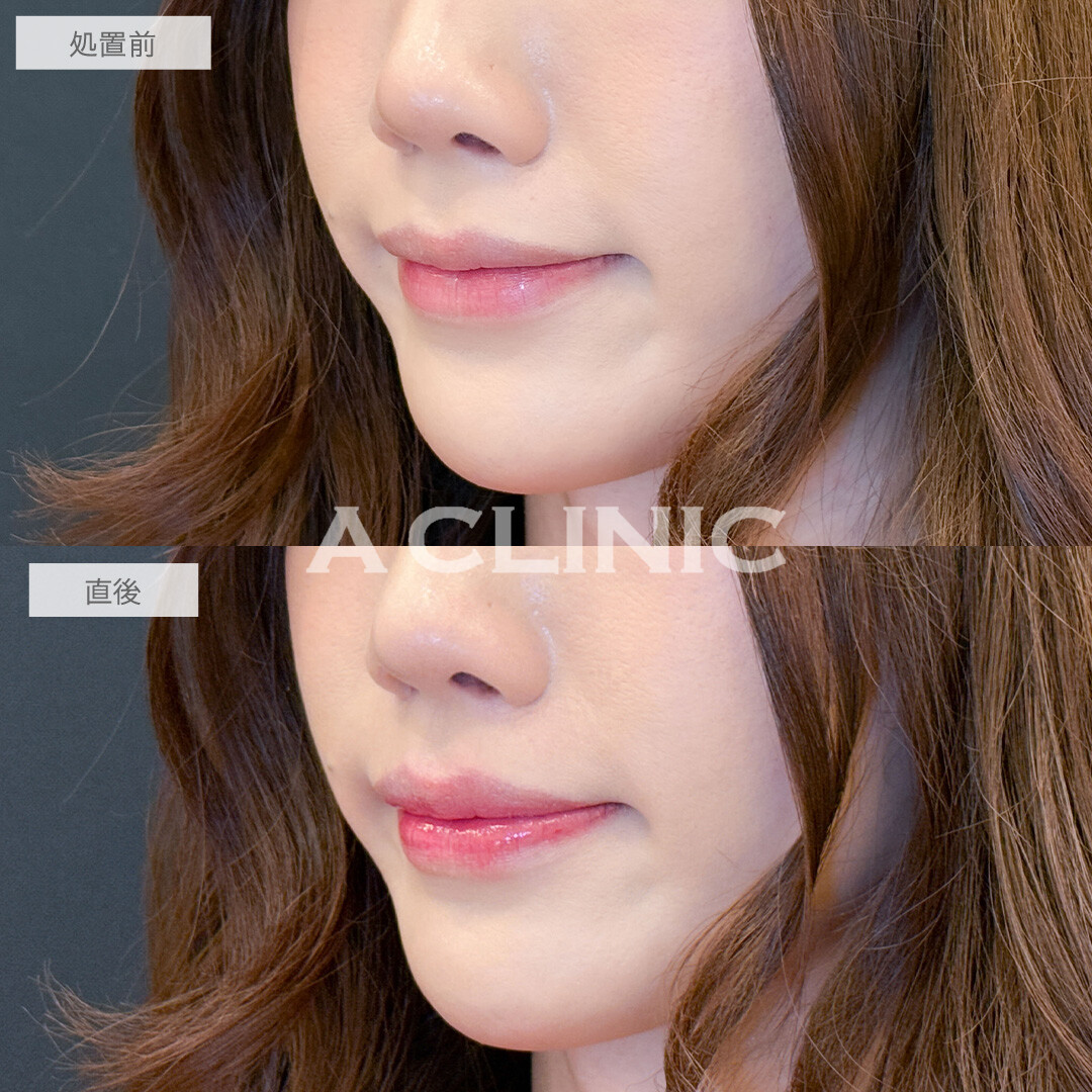 スマイルリップは唇を似合う形にカスタマイズできます！こちら処置前と直後の症例です(30代)
