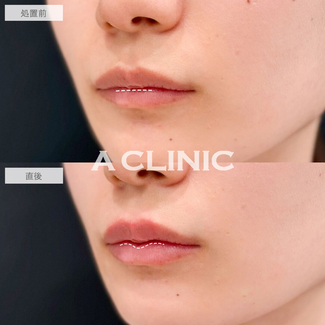 リップヒアルロン酸注入でナチュラルにボリュームアップしM字のぷっくり可愛らしい唇になりました！処置前と直後の症例です(20代女性)