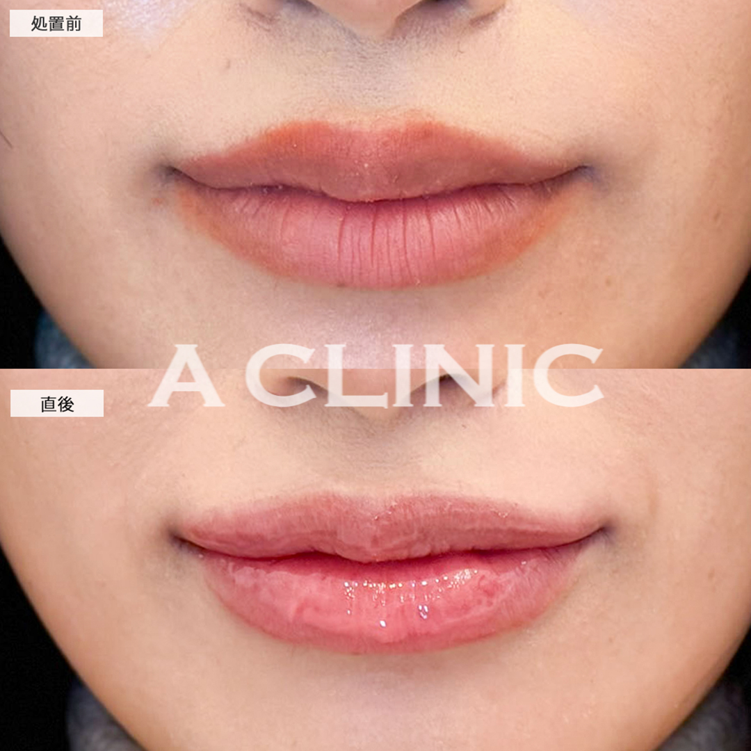 スマイルリップで唇にボリュームが出てグラマラスな印象に！こちら処置前と直後の症例です(20代女性)
