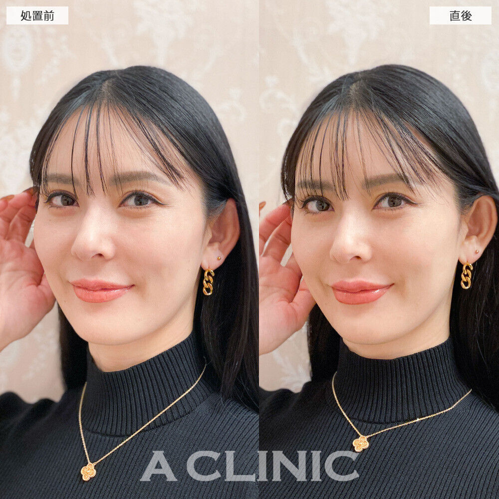 スマイルリップで存在感のある唇になりお顔がハッキリしました！こちら処置前と直後の症例です(30代女性)