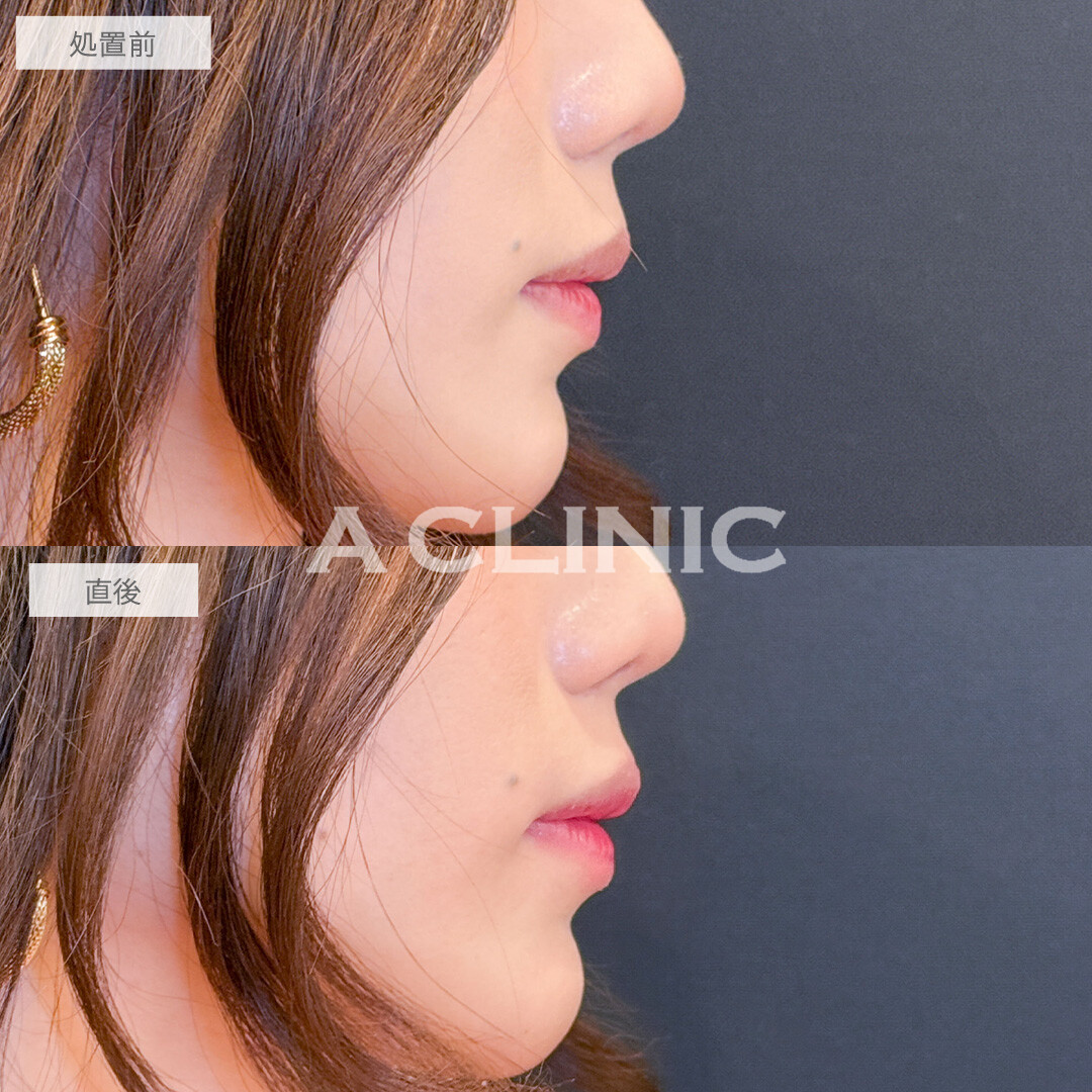 スマイルリップは唇を似合う形にカスタマイズできます！こちら処置前と直後の症例です(30代)