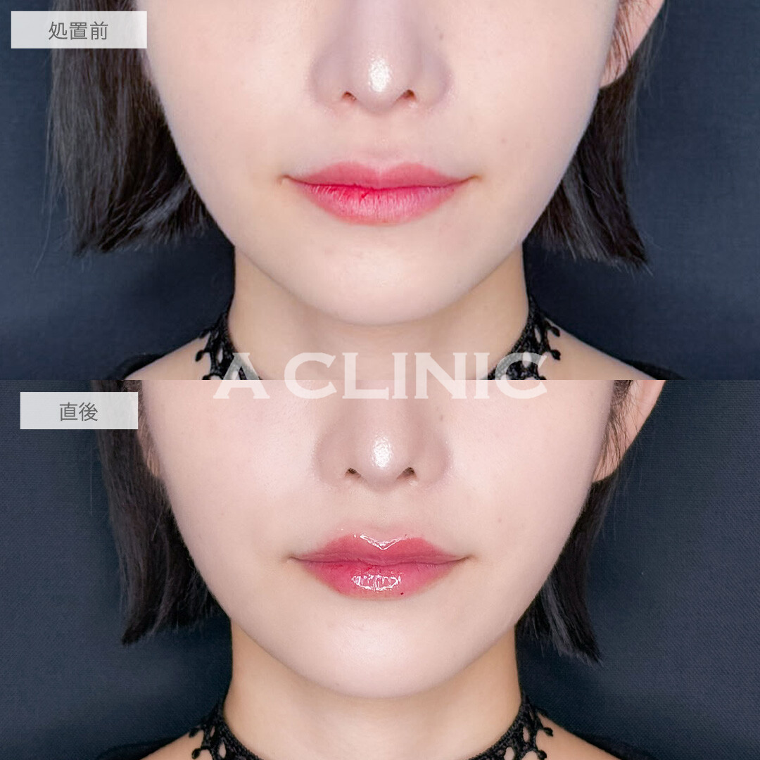 スマイルリップでさりげなく印象チェンジ！こちら処置前と直後の症例です(20代女性)