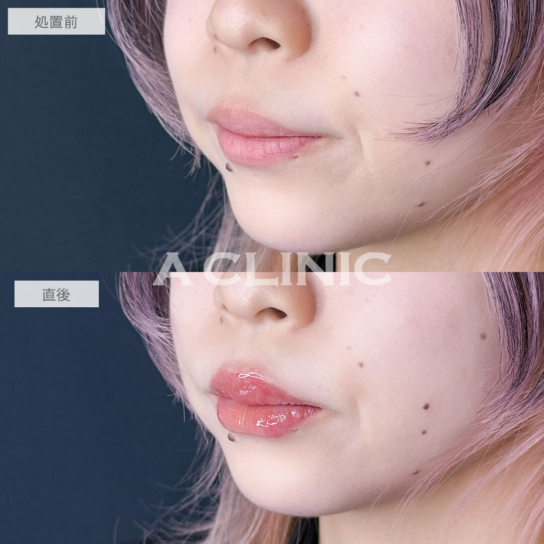 スマイルリップでボリューム感のある魅力的な唇に！こちら処置前と直後の症例です(10代女性)