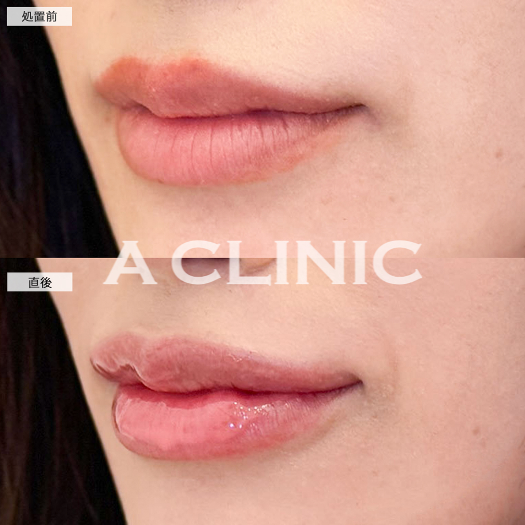 スマイルリップで唇にボリュームが出てグラマラスな印象に！こちら処置前と直後の症例です(20代女性)