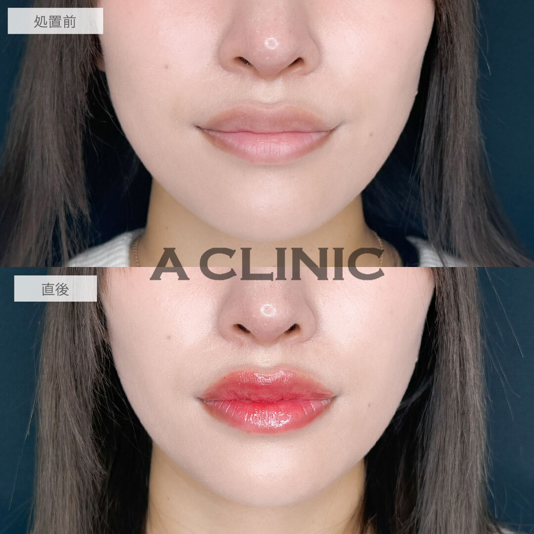 スマイルリップで理想の唇を実現させます！こちら処置前と直後の症例です(20代女性)