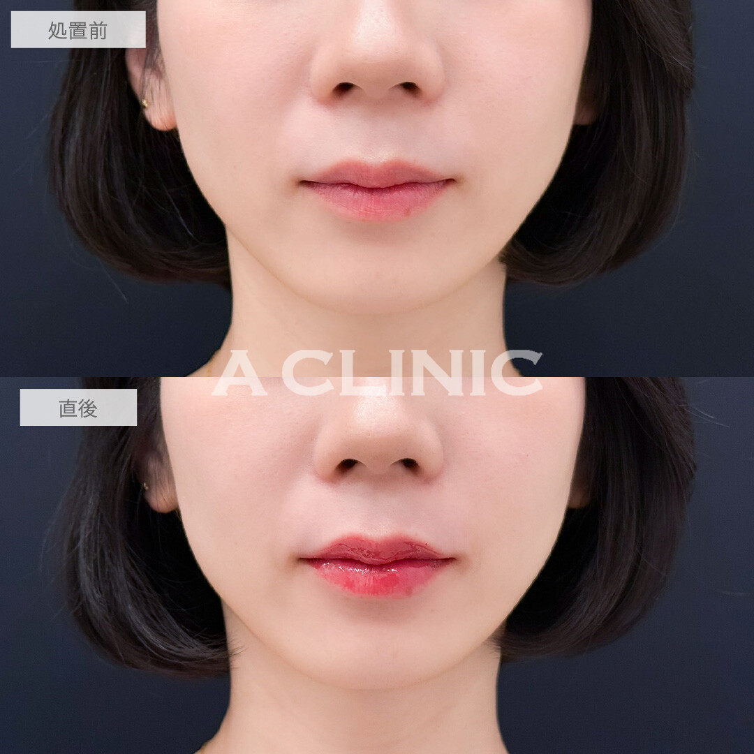 スマイルリップで唇にボリューム感が出てより魅力的な雰囲気に！こちら処置前と直後の症例です(30代女性)