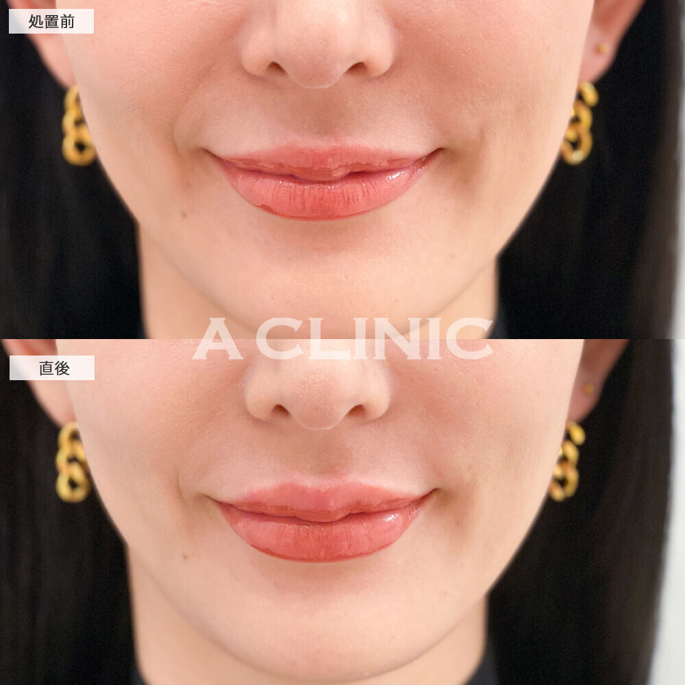 スマイルリップで存在感のある唇になりお顔がハッキリしました！こちら処置前と直後の症例です(30代女性)