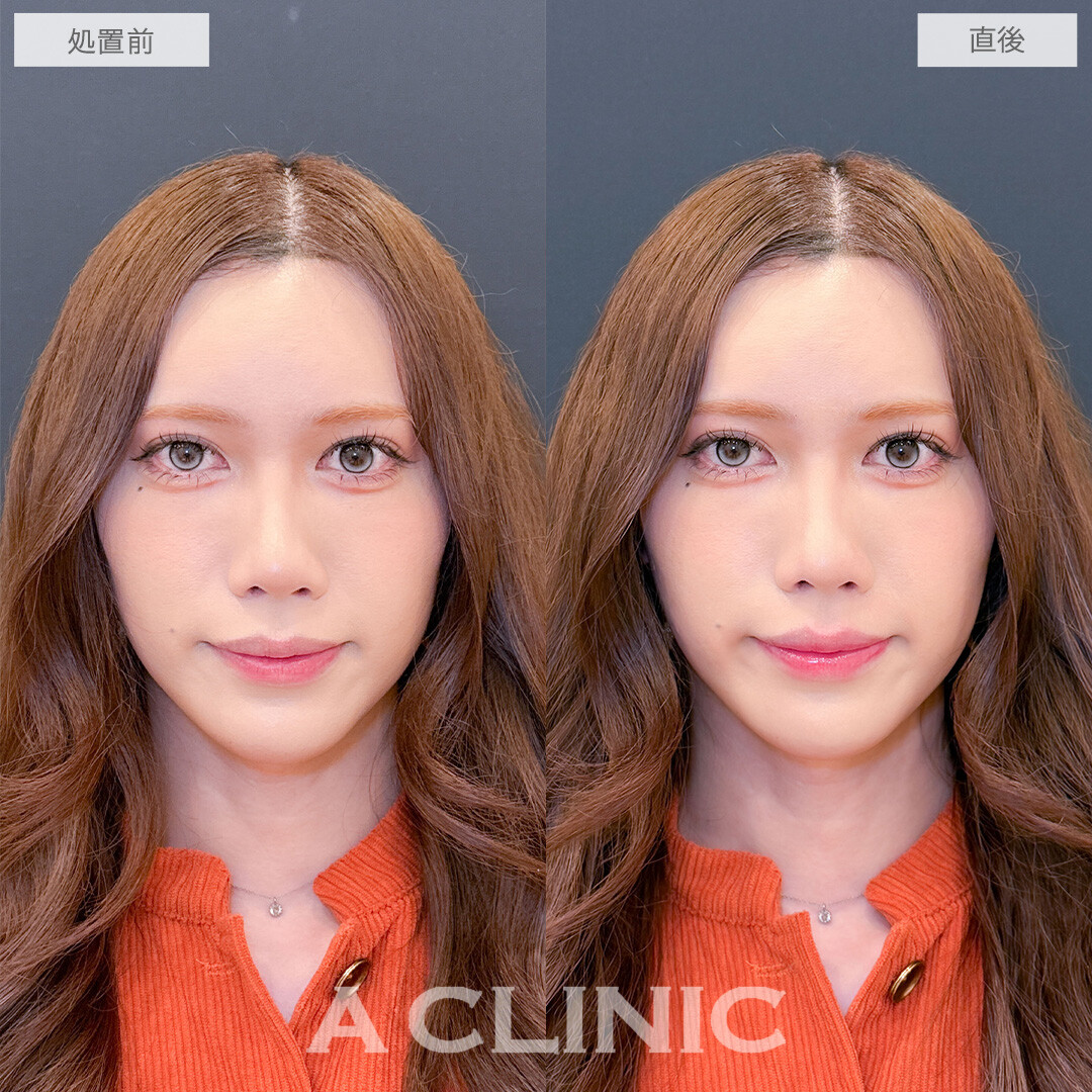 スマイルリップは唇を似合う形にカスタマイズできます！こちら処置前と直後の症例です(30代)