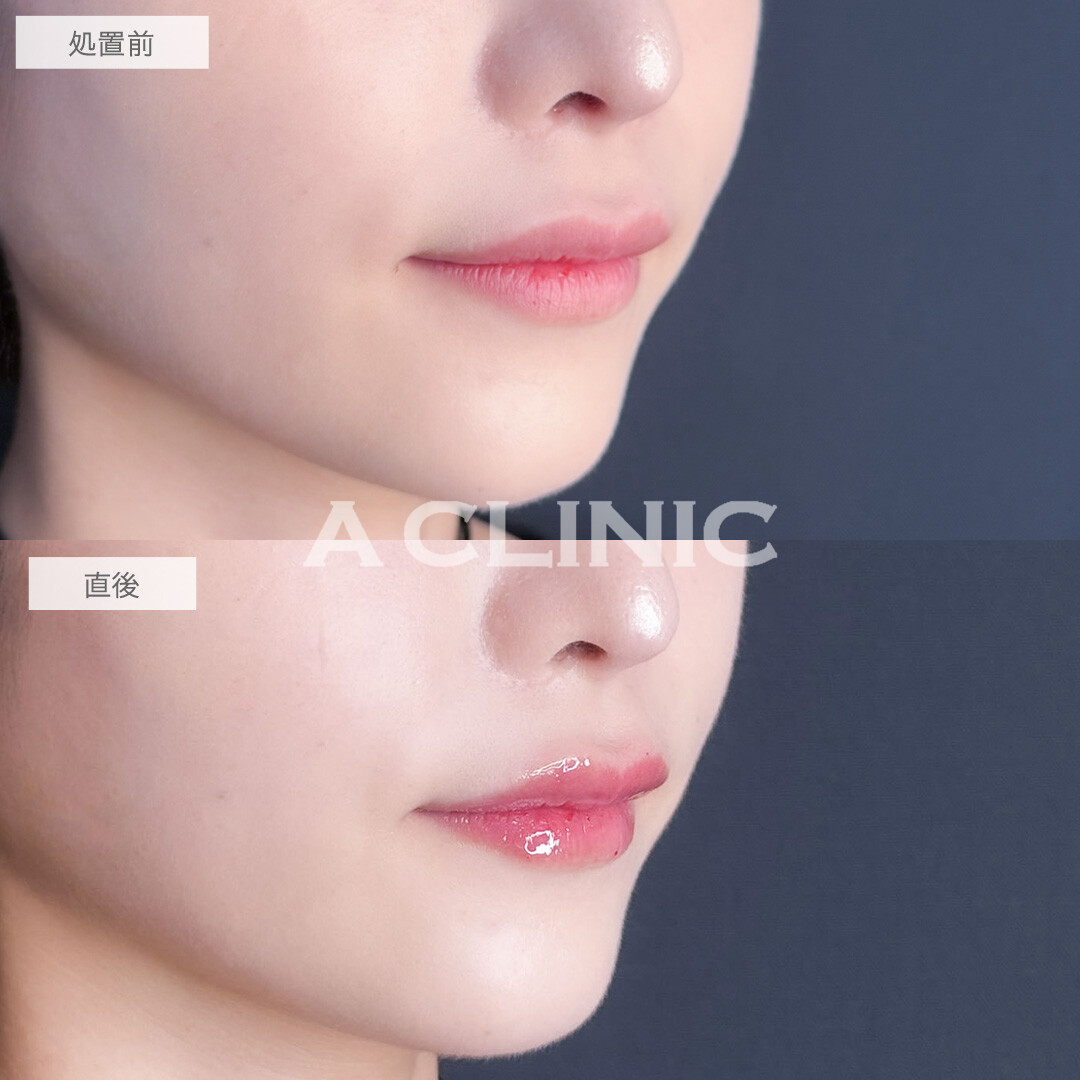 スマイルリップでさりげなく印象チェンジ！こちら処置前と直後の症例です(20代女性)