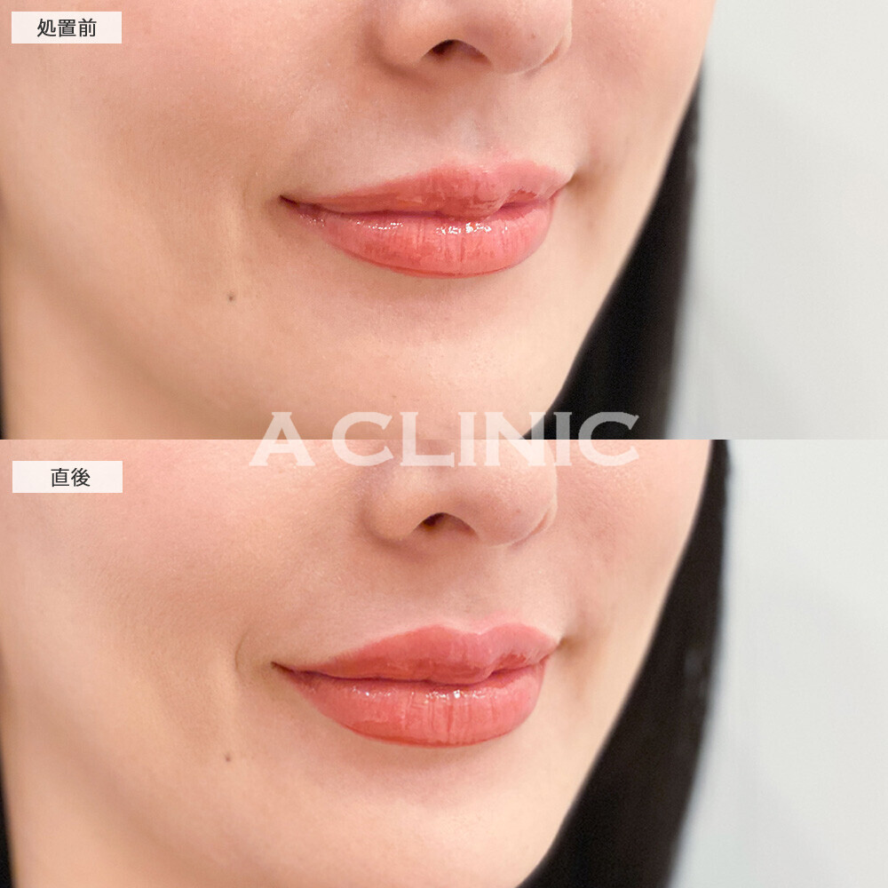 スマイルリップで存在感のある唇になりお顔がハッキリしました！こちら処置前と直後の症例です(30代女性)