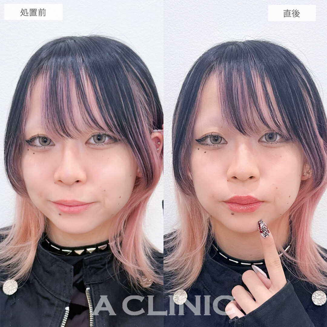 スマイルリップでボリューム感のある魅力的な唇に！こちら処置前と直後の症例です(10代女性)