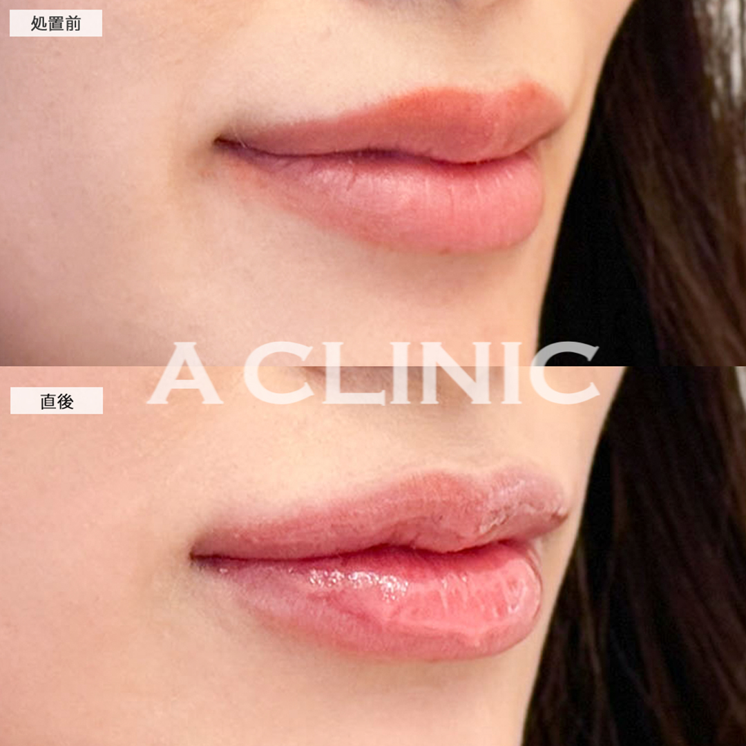 スマイルリップで唇にボリュームが出てグラマラスな印象に！こちら処置前と直後の症例です(20代女性)