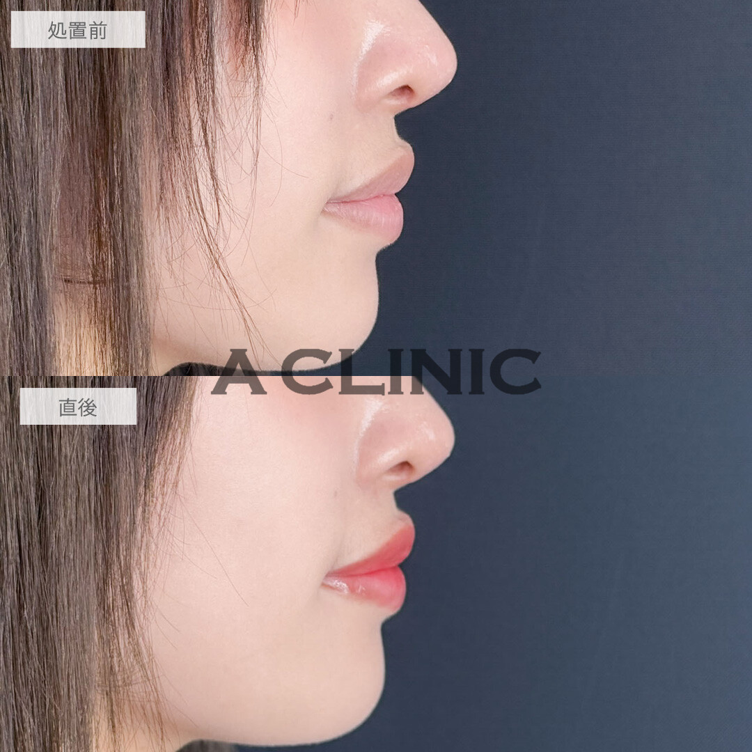 スマイルリップで理想の唇を実現させます！こちら処置前と直後の症例です(20代女性)