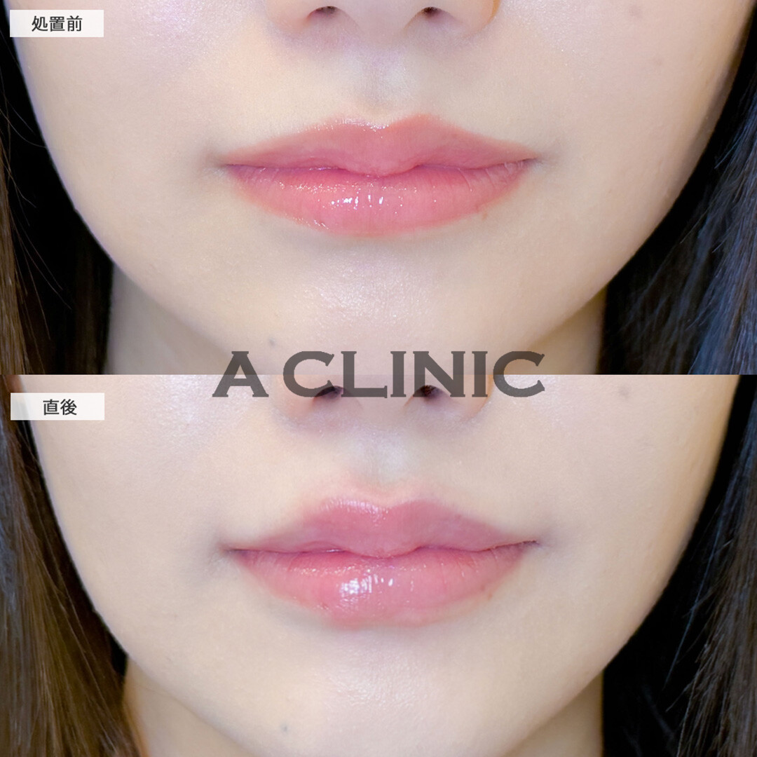 スマイルリップで左右差を整えナチュラルに唇がボリュームアップしました！こちら処置前と直後の症例です(20代女性)