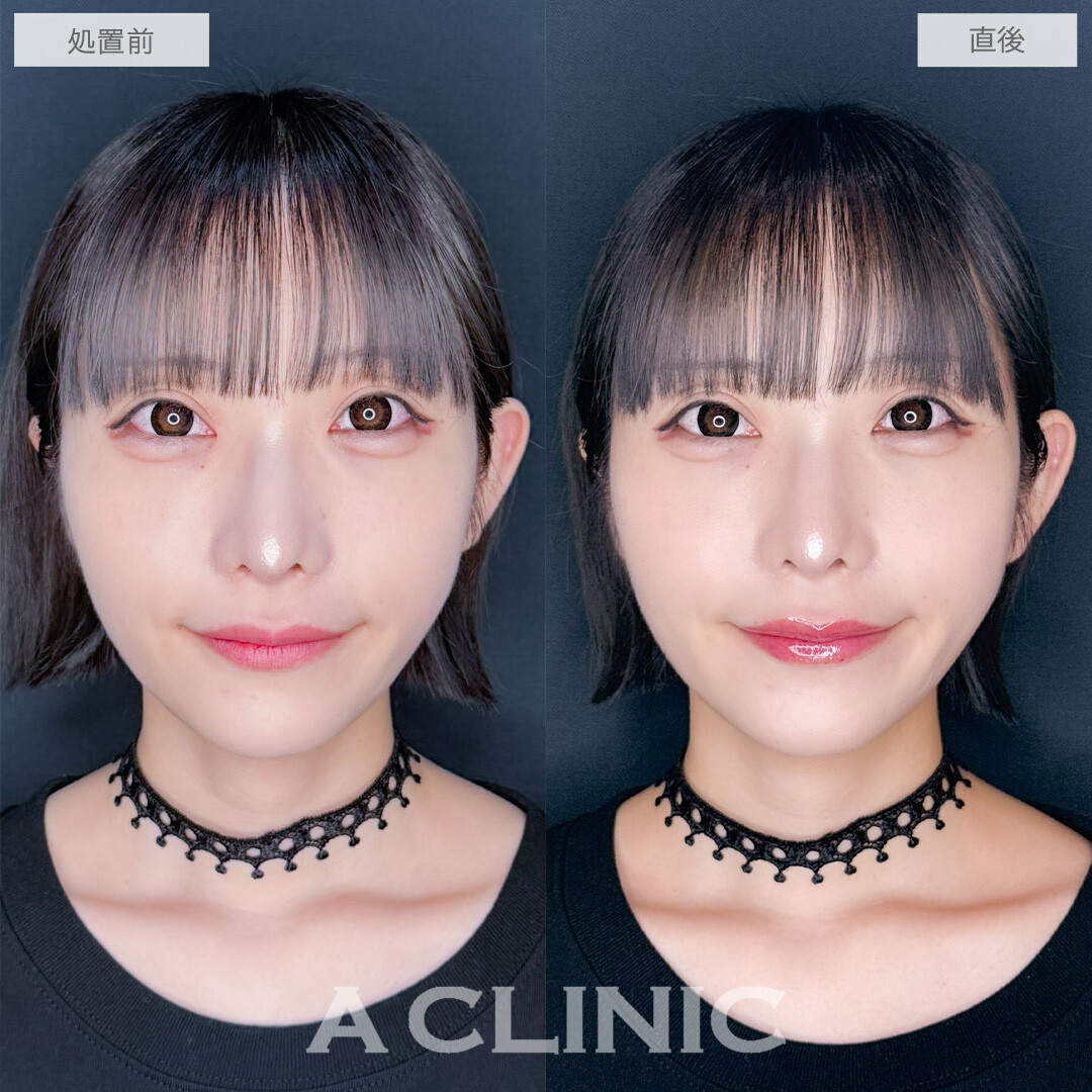 スマイルリップでさりげなく印象チェンジ！こちら処置前と直後の症例です(20代女性)