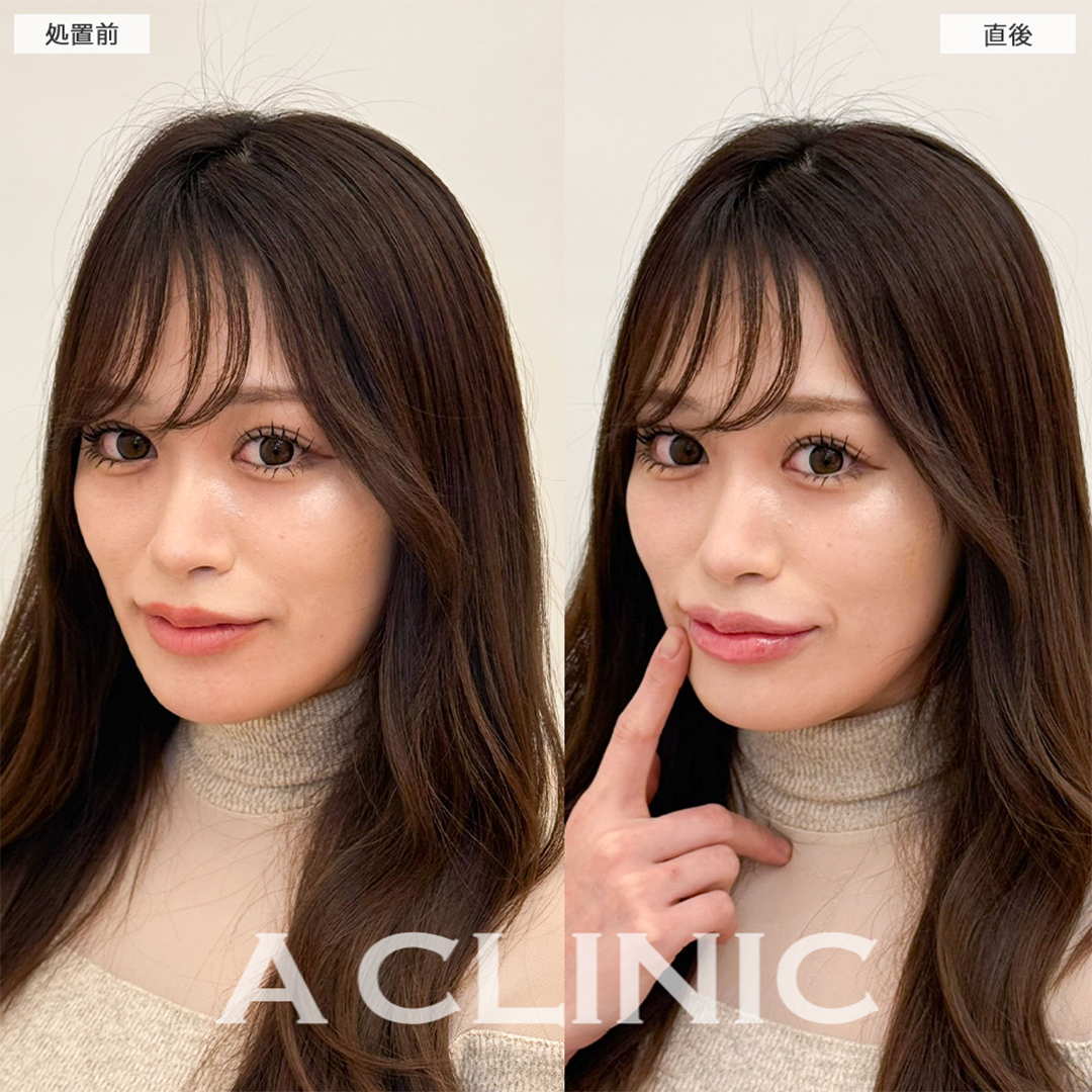 スマイルリップで唇にボリュームが出てグラマラスな印象に！こちら処置前と直後の症例です(20代女性)