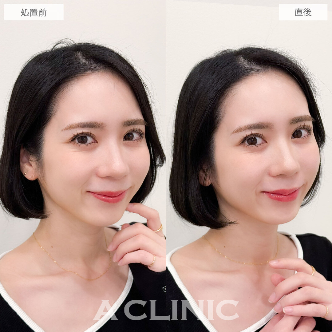 スマイルリップで唇にボリューム感が出てより魅力的な雰囲気に！こちら処置前と直後の症例です(30代女性)