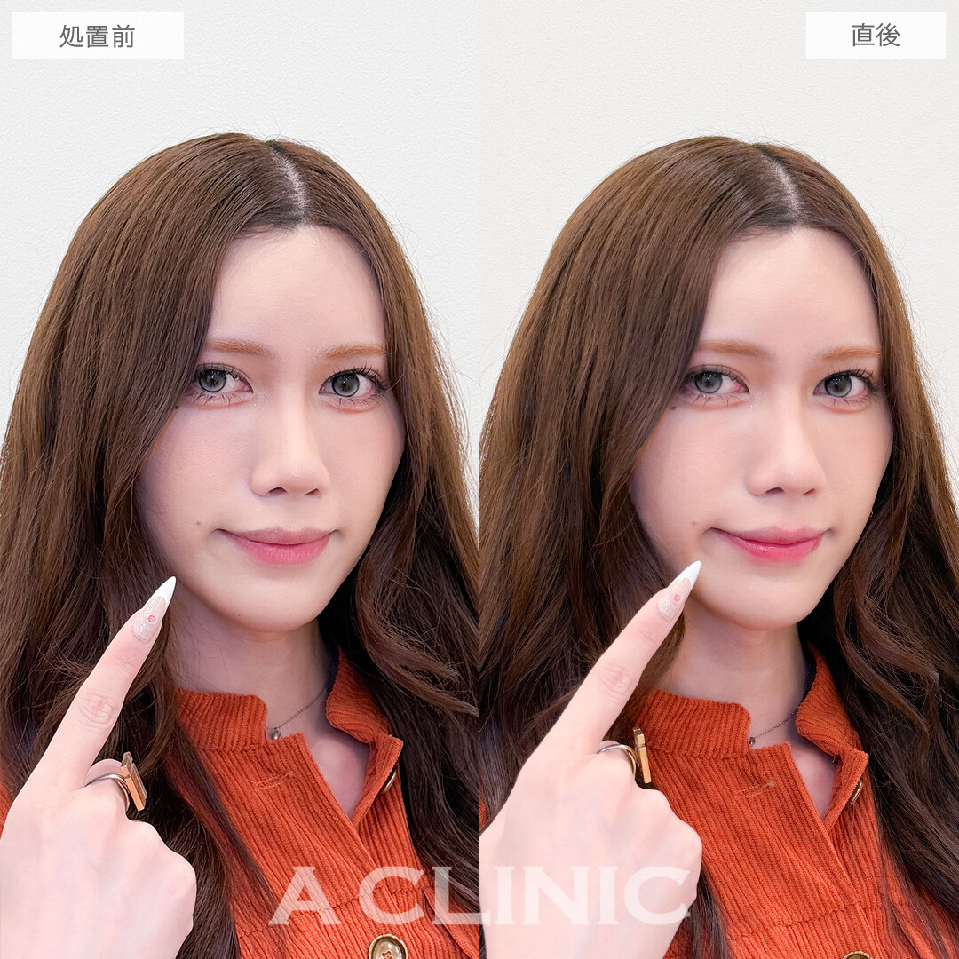 スマイルリップは唇を似合う形にカスタマイズできます！こちら処置前と直後の症例です(30代)