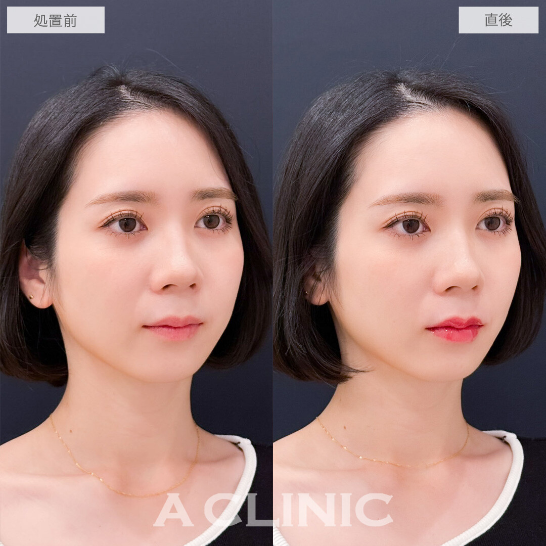 スマイルリップで唇にボリューム感が出てより魅力的な雰囲気に！こちら処置前と直後の症例です(30代女性)