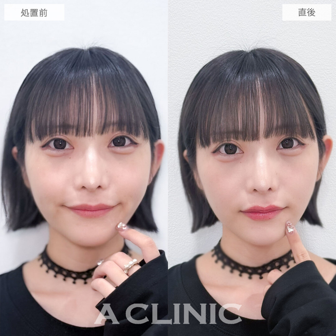 スマイルリップでさりげなく印象チェンジ！こちら処置前と直後の症例です(20代女性)