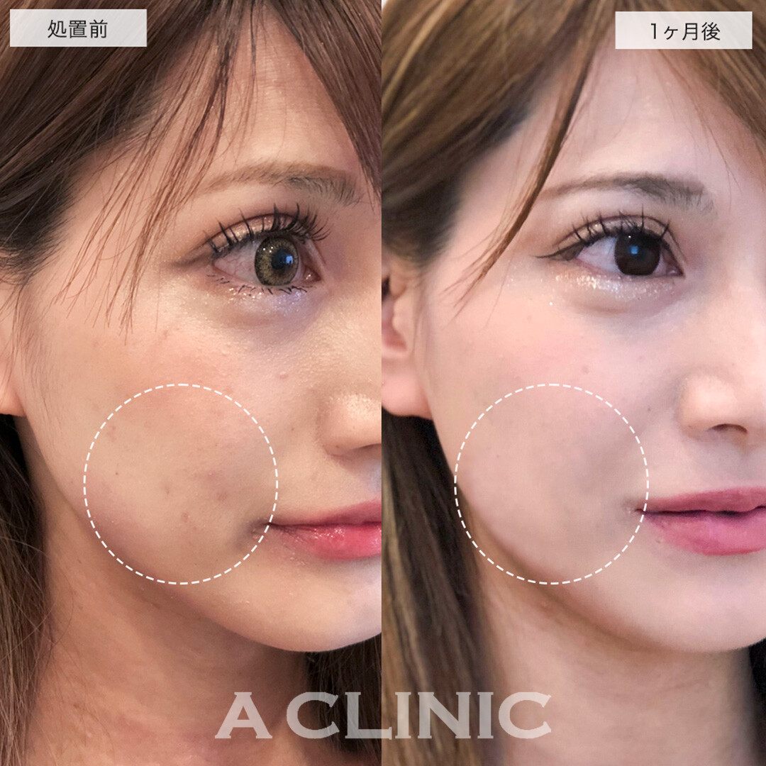 水光注射で肌トラブル改善し潤い感じる素肌へ!こちら処置前と1ヶ月後の症例です(20代女性)