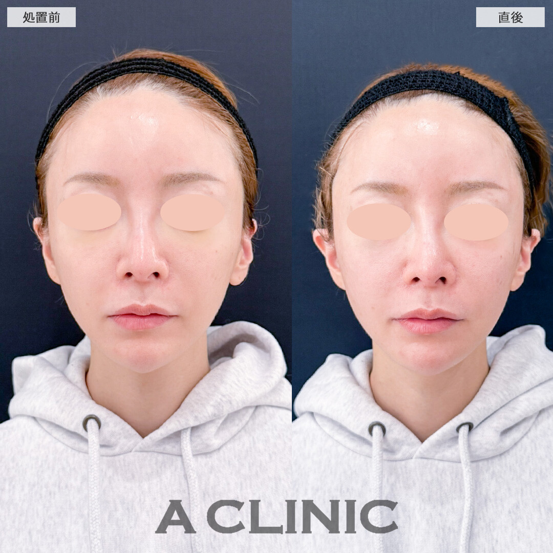 立ち耳ヒアルロン酸注入(ボリューマ)したら童顔になってお顔の印象が柔らかくなりました！こちら処置前と直後の症例です(30代女性)