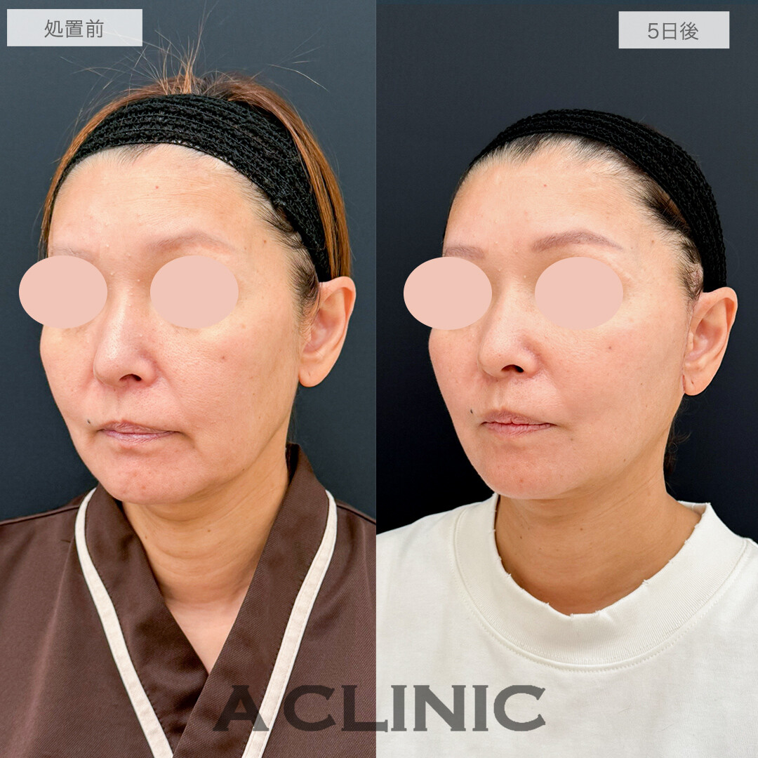 A式美肌たるみ切開と1day小顔脂肪吸引で劇的若返り!処置前と5日後の症例です(50代女性)
