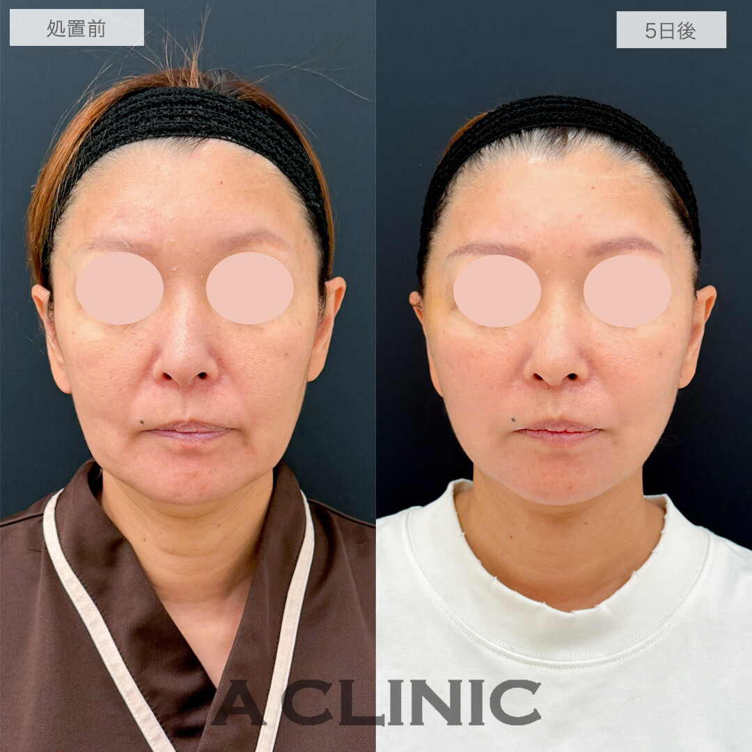 A式美肌たるみ切開と1day小顔脂肪吸引で劇的若返り!処置前と5日後の症例です(50代女性)