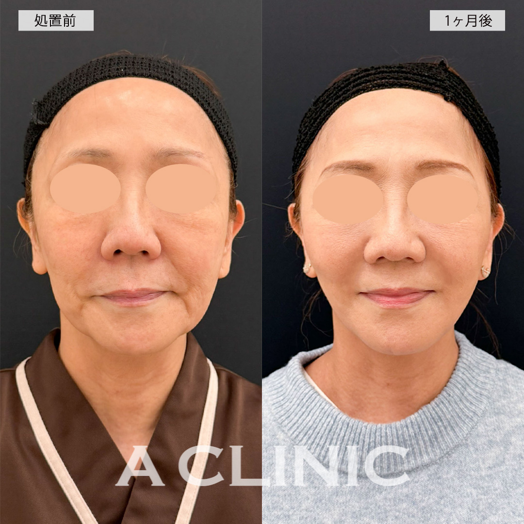 A式美肌たるみ切開と1day小顔脂肪吸引でたるみがかなり改善され若返りに成功しました！こちら処置前と1ヶ月後の症例です(60代女性)