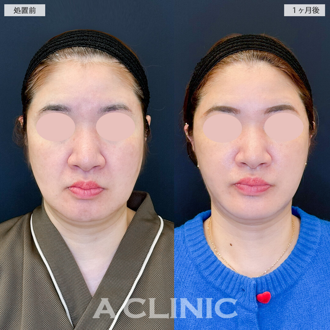 1day小顔脂肪吸引とA式美肌たるみ切開で皮膚や脂肪のたるみもスッキリ改善！処置前と１ヶ月後の症例です(40代女性)