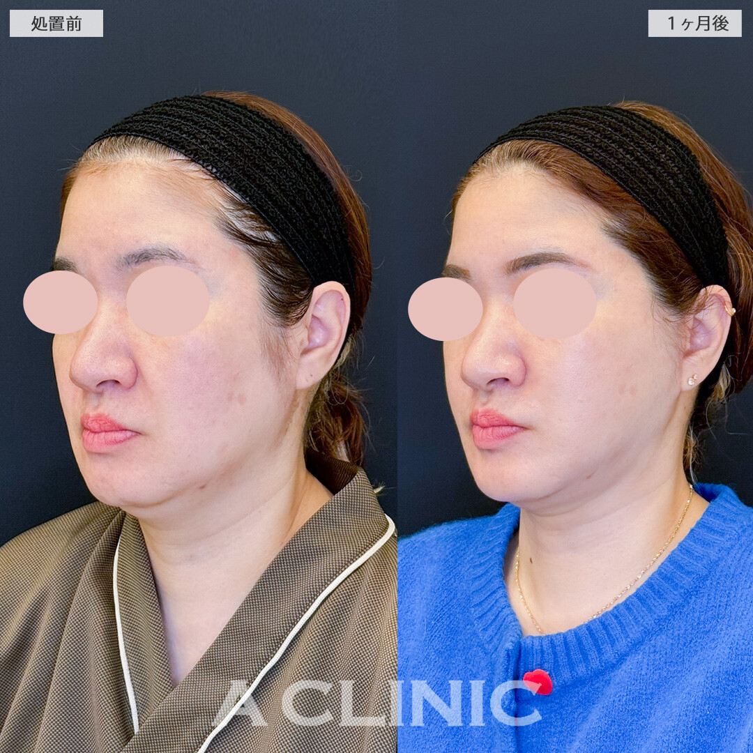 1day小顔脂肪吸引とA式美肌たるみ切開で皮膚や脂肪のたるみもスッキリ改善！処置前と１ヶ月後の症例です(40代女性)