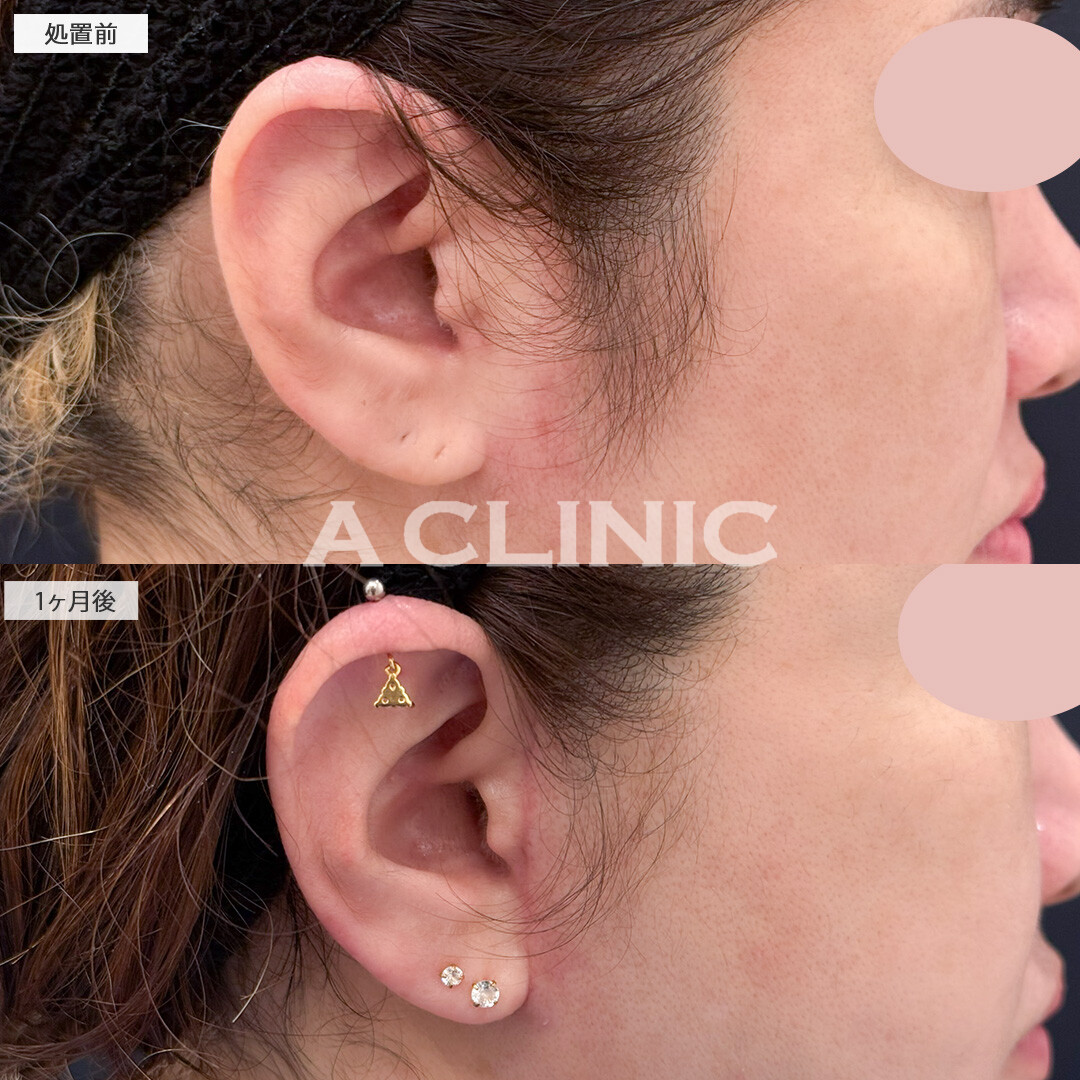 1day小顔脂肪吸引とA式美肌たるみ切開で皮膚や脂肪のたるみもスッキリ改善！処置前と１ヶ月後の症例です(40代女性)