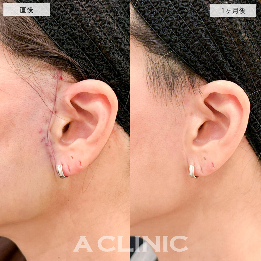 A式美肌たるみ切開と1day小顔脂肪吸引の組み合わせでたるみとほうれい線が改善しました!こちら処置前と1ヶ月後の症例です(40代女性)