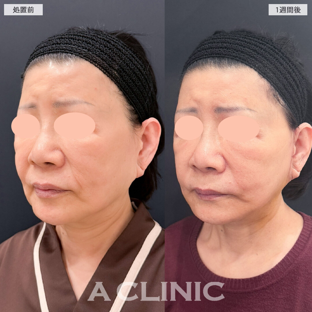 A式美肌たるみ切開と1day小顔脂肪吸引で年齢が出る口横のたるみをなくせました！こちら処置前と1週間後の症例です(60代女性)