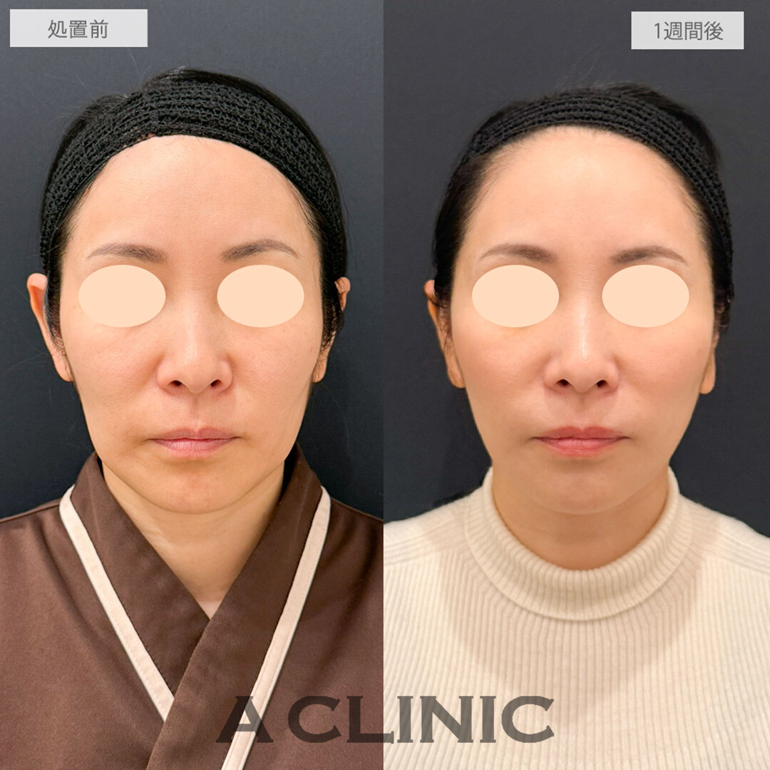【直後の傷跡あり】A式美肌たるみ切開とPRP血小板療法でダウンタイム少なく若返り！処置前と1週間後の症例です(40代女性)