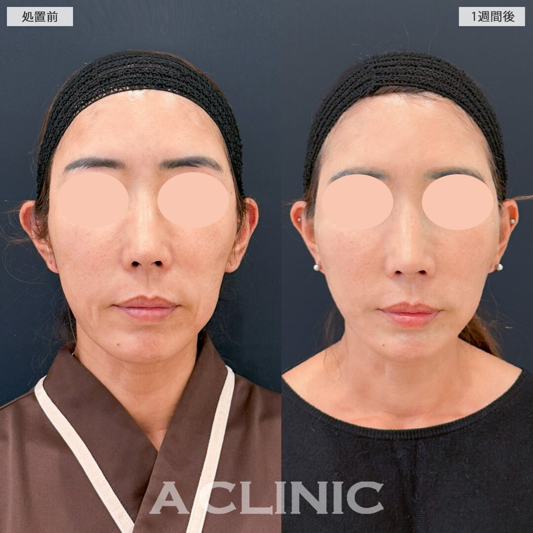 A式美肌たるみ切開でほうれい線や口元のたるみもほとんど目立たなくなりました！処置前と1週間後の症例です(50代女性)