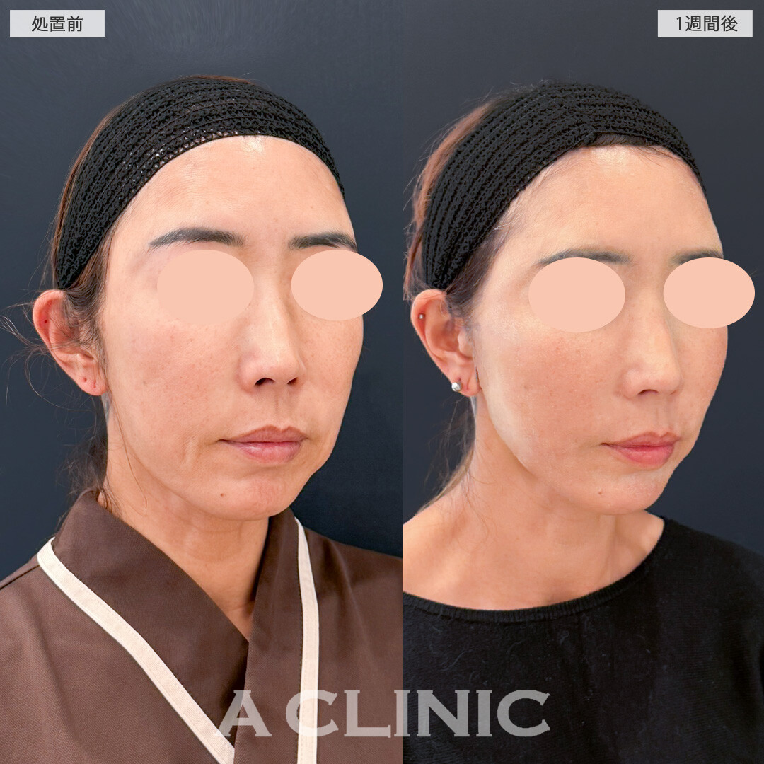 A式美肌たるみ切開でほうれい線や口元のたるみもほとんど目立たなくなりました！処置前と1週間後の症例です(50代女性)