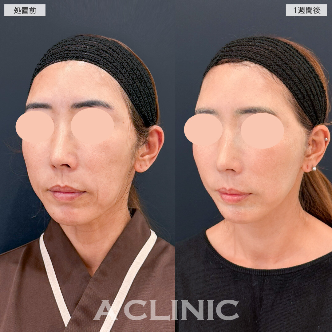 A式美肌たるみ切開でほうれい線や口元のたるみもほとんど目立たなくなりました！処置前と1週間後の症例です(50代女性)