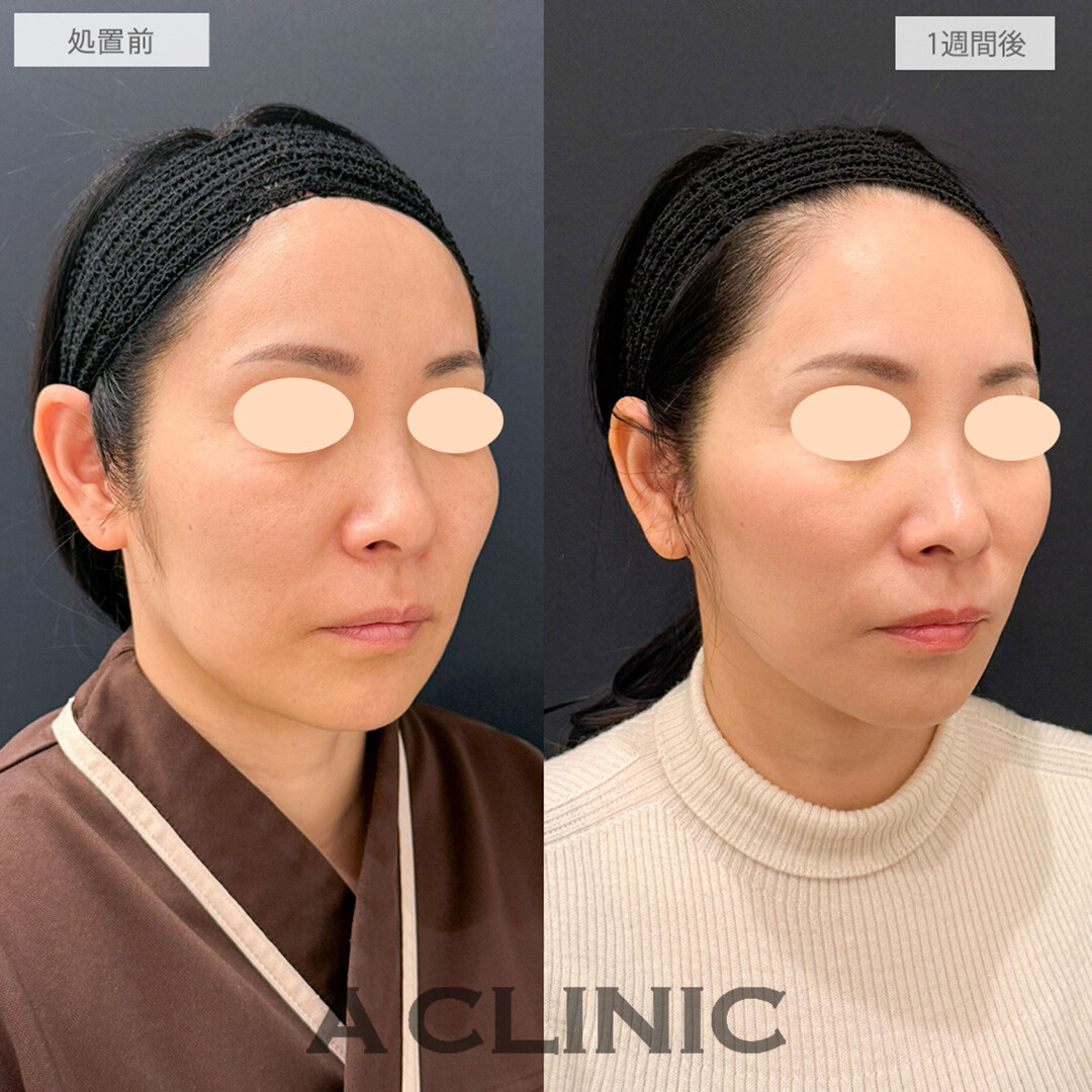 【直後の傷跡あり】A式美肌たるみ切開とPRP血小板療法でダウンタイム少なく若返り！処置前と1週間後の症例です(40代女性)