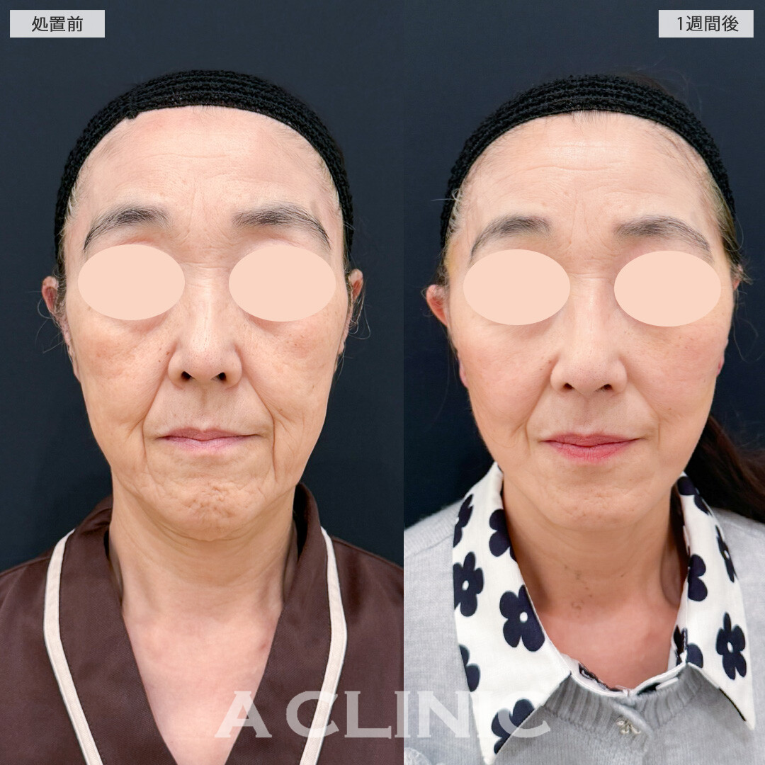 A式美肌たるみ切開でたるみを引き上げ凹凸も解消！処置前と1週間後の症例です(60代女性)