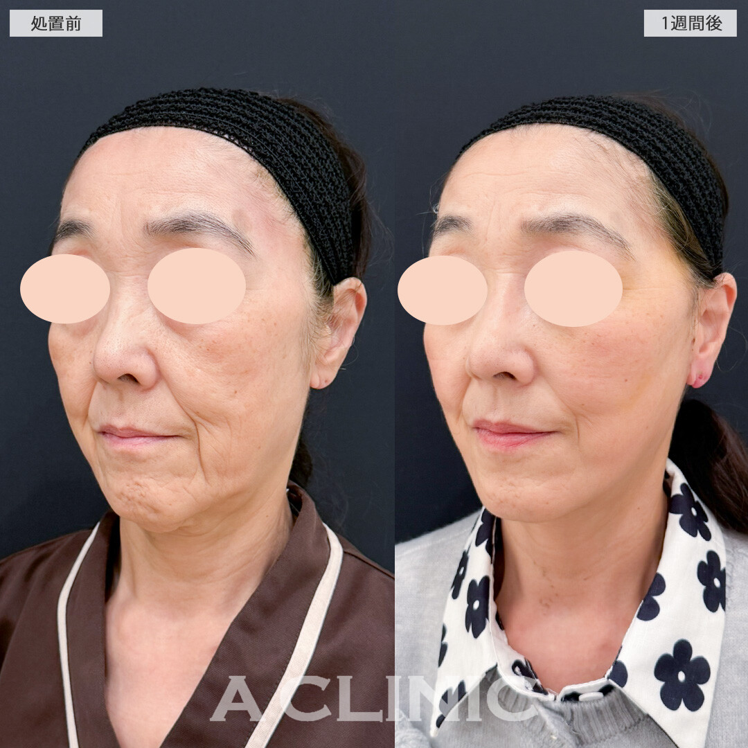 A式美肌たるみ切開でたるみを引き上げ凹凸も解消！処置前と1週間後の症例です(60代女性)