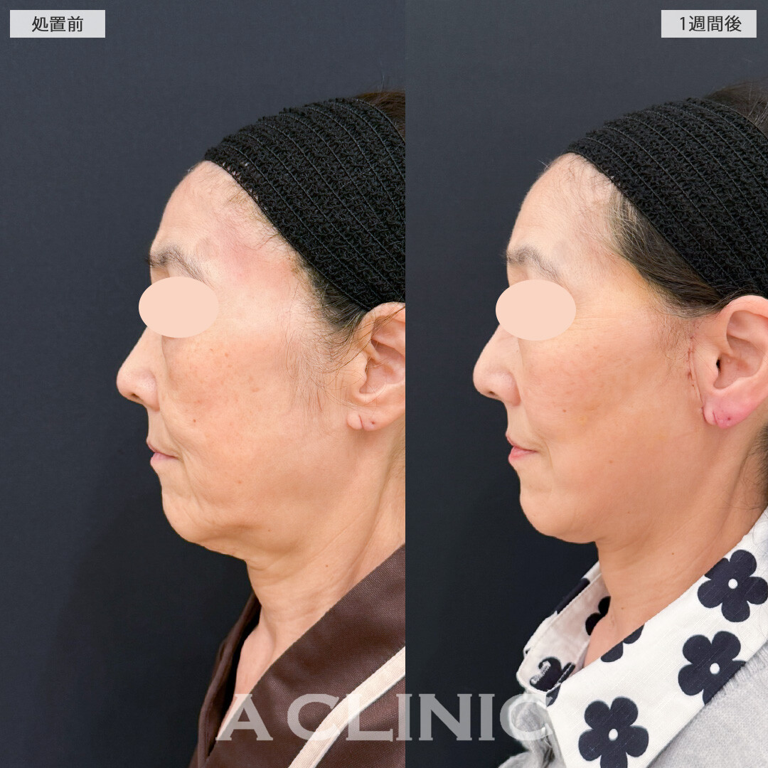 A式美肌たるみ切開でたるみを引き上げ凹凸も解消！処置前と1週間後の症例です(60代女性)