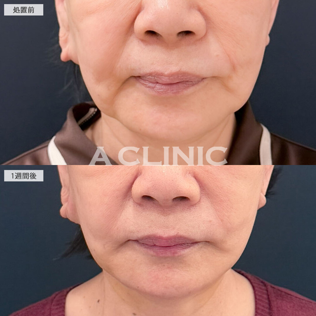 A式美肌たるみ切開と1day小顔脂肪吸引で年齢が出る口横のたるみをなくせました！こちら処置前と1週間後の症例です(60代女性)
