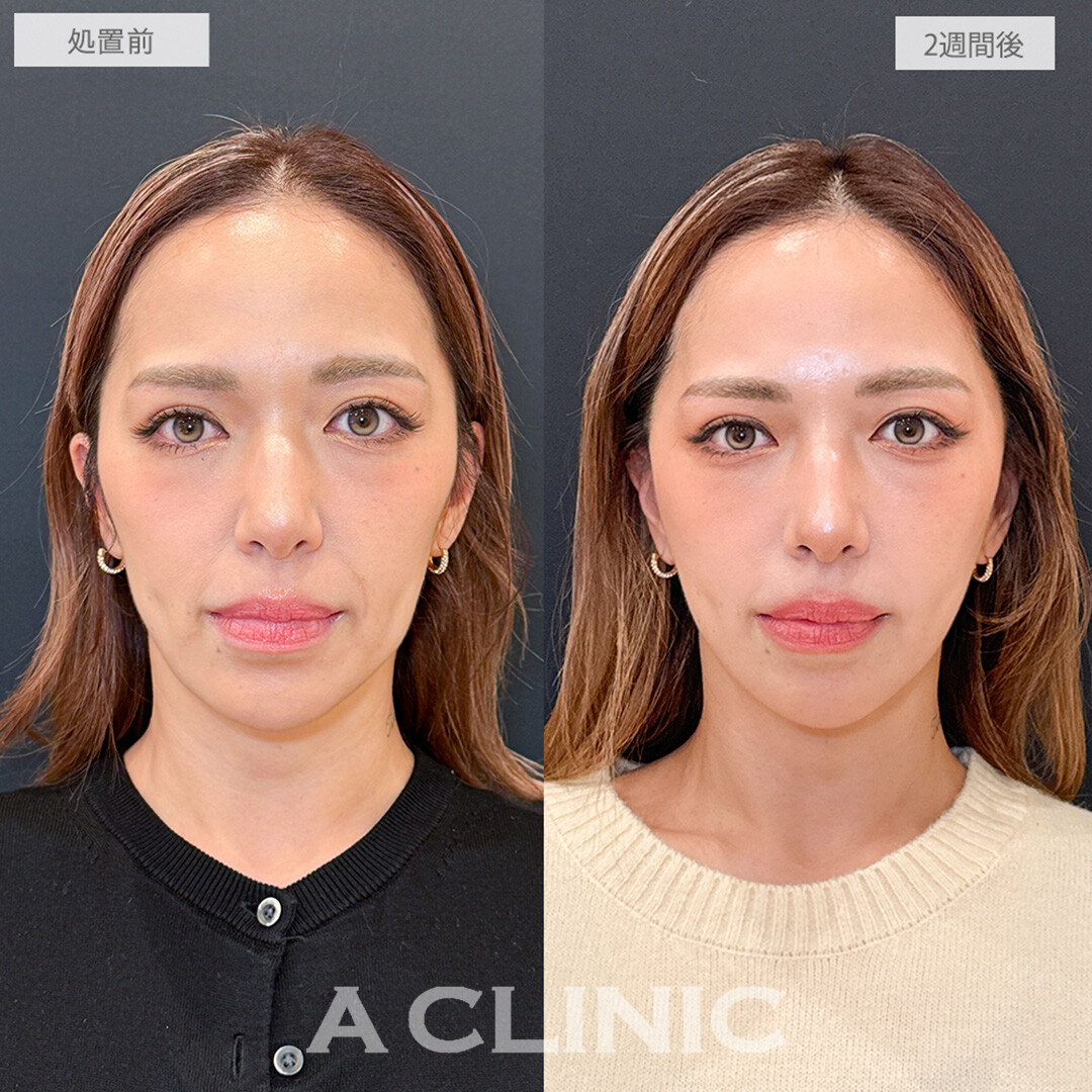 【直後の傷跡あり】A式美肌たるみ切開でほうれい線やたるみが劇的に改善！こちら処置前と2週間後の症例です(40代女性)