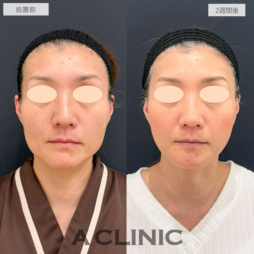 【直後の傷跡あり】A式美肌たるみ切開でなだらかな卵型の輪郭に！処置前と2週間後の症例です(40代女性)